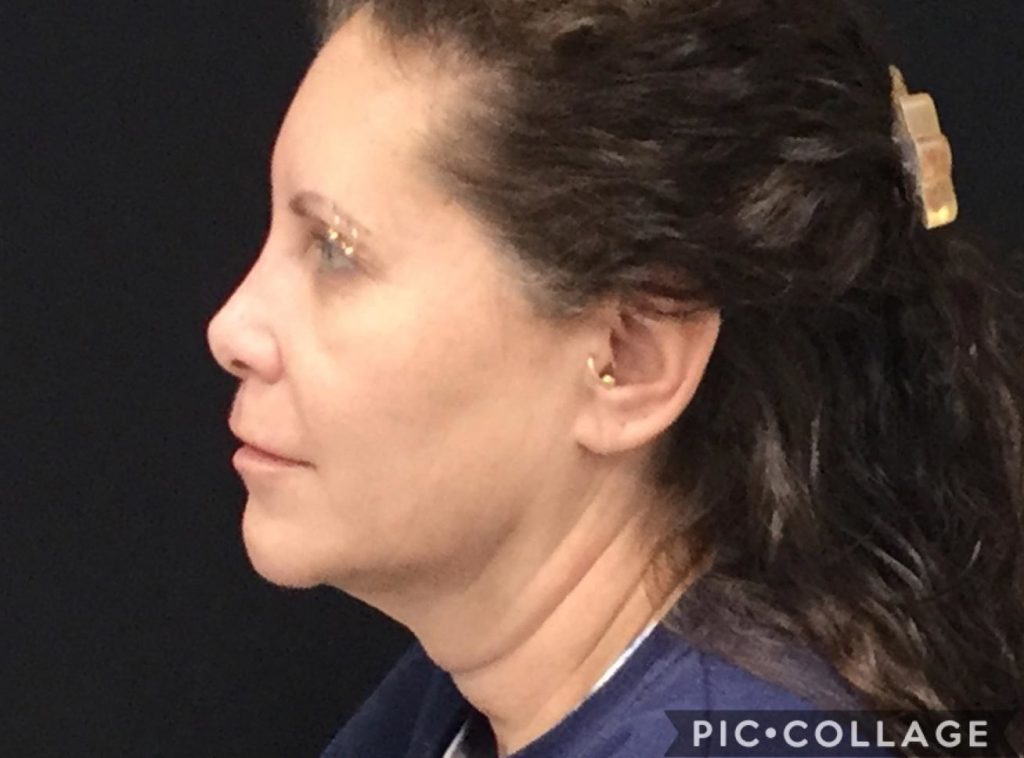 After Coolsculpt - Neck